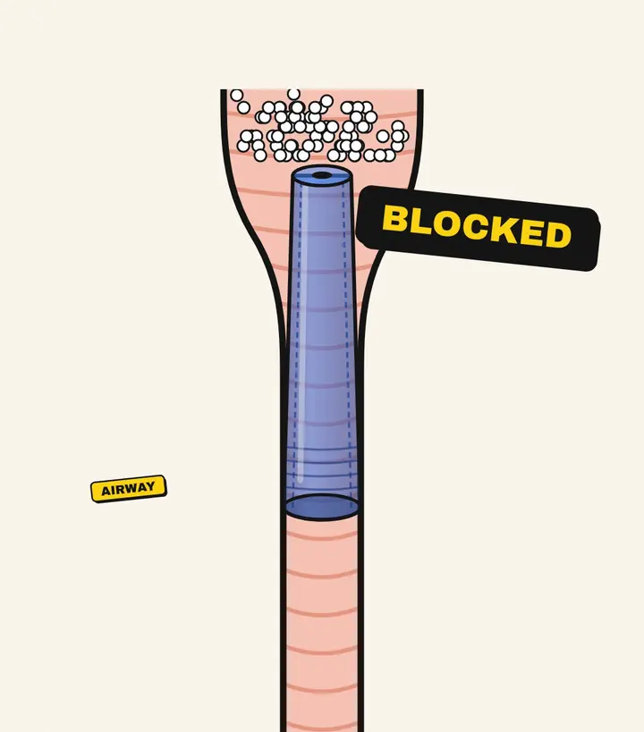 Cross-section of a windpipe with a blue pen cap wedged in it, air bubbles piling up above it and a label reading 'Blocked'